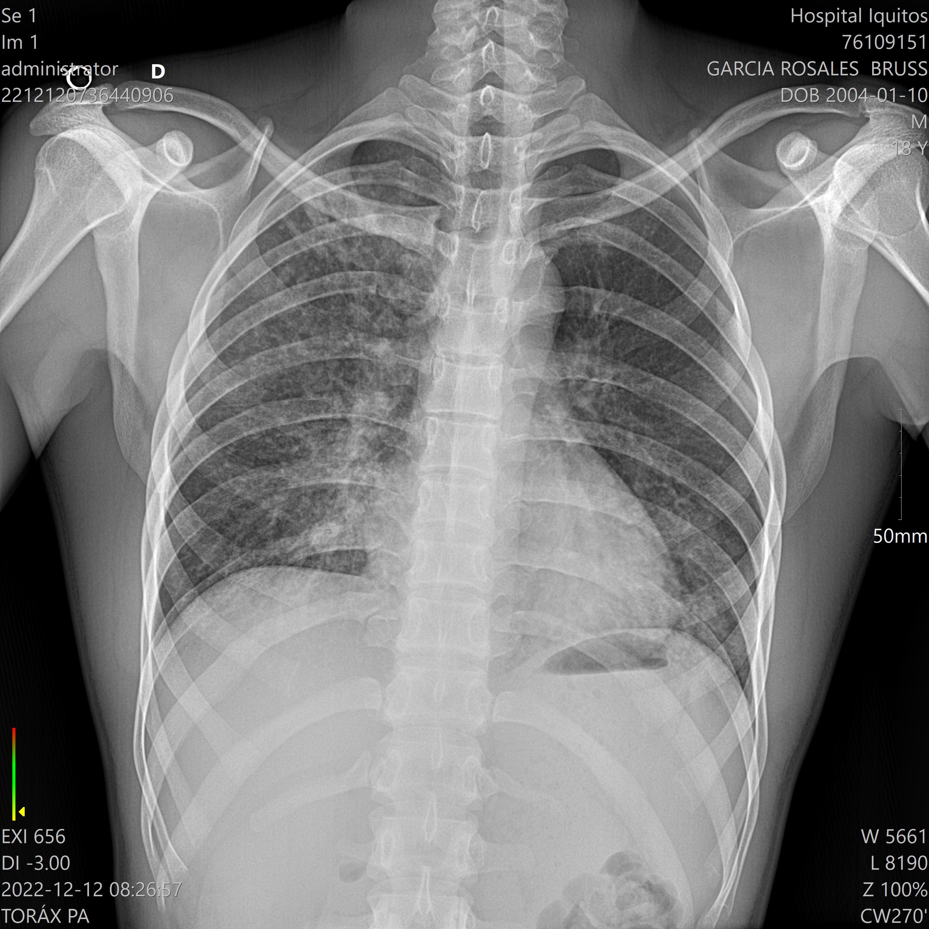 Placa Pecho Normal Detalle - placa