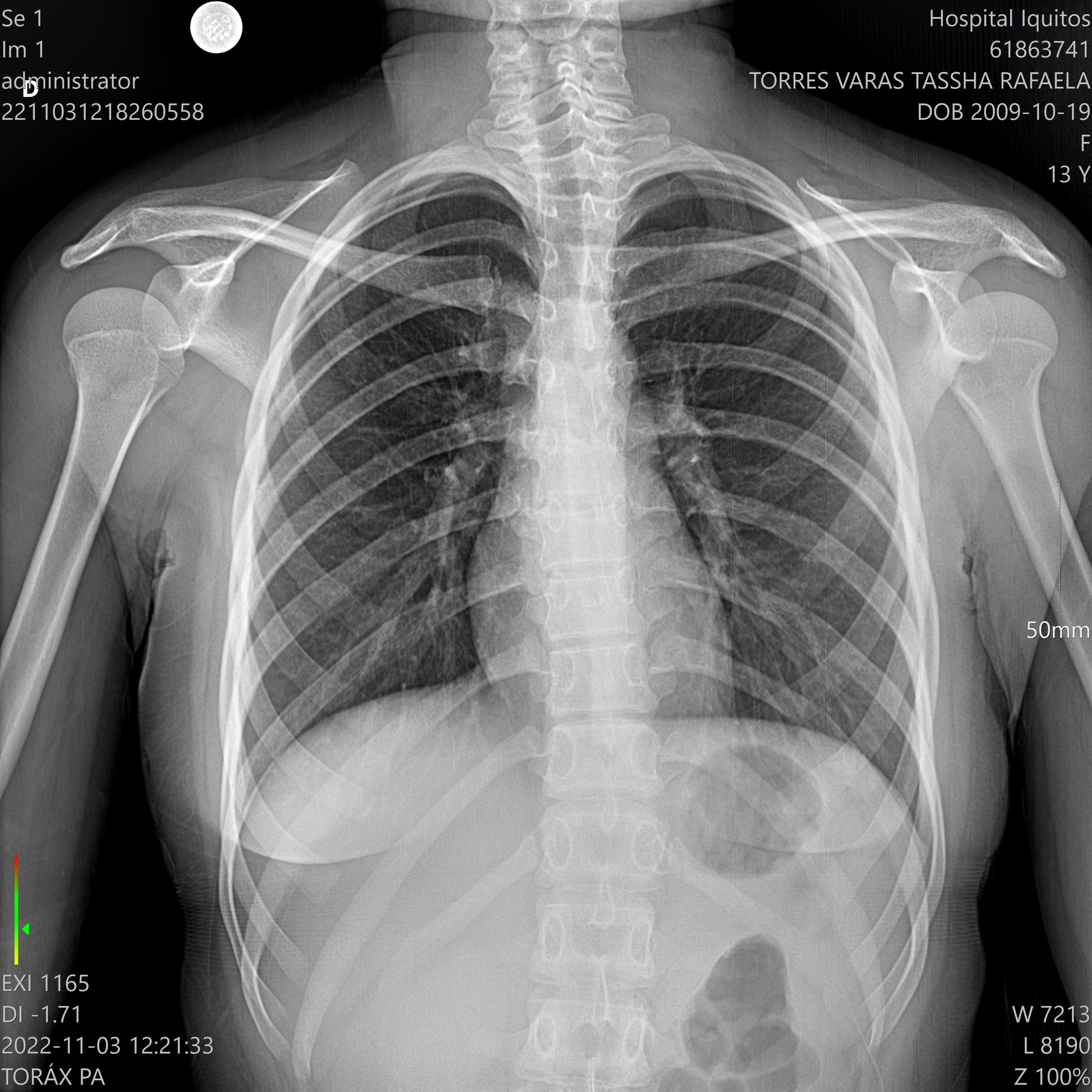 Placa Pecho Normal Detalle - placa