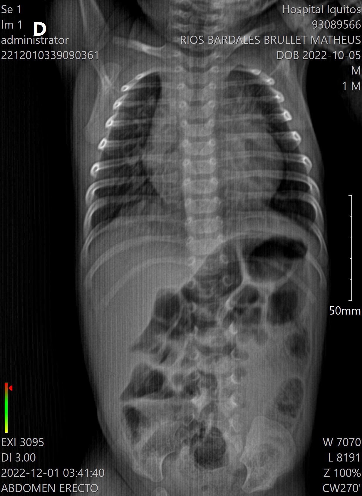 Placa Pecho Normal Detalle - placa